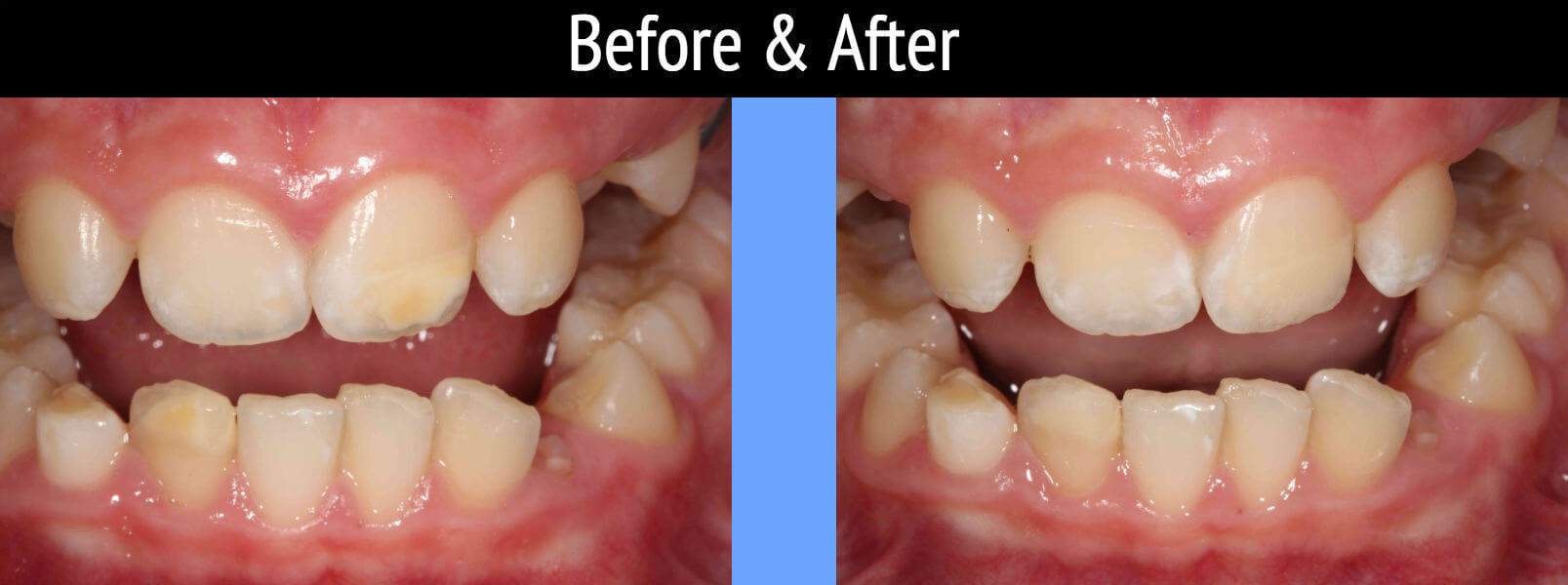 Dental Bonding Before and After